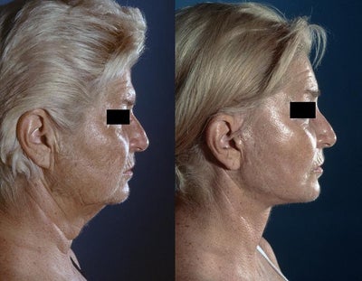 Facelift before and after photo