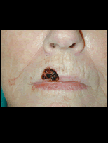 https://fi.realself.com/full/b/e/c/Mohs-Surgery-before-84503.gif