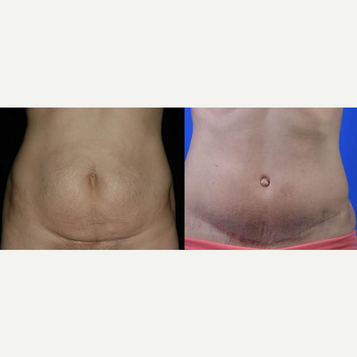 Mini Tummy Tuck before and after photo
