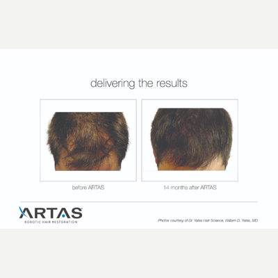 ARTAS Robotic Hair Transplant before and after photo