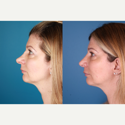 Revision Rhinoplasty before and after photo