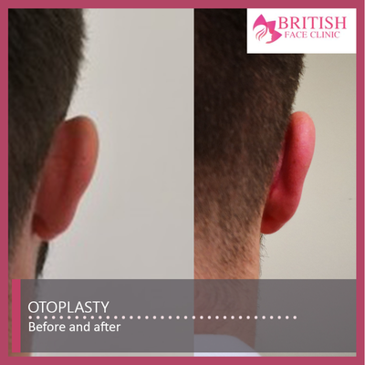 Ear Surgery before and after photo