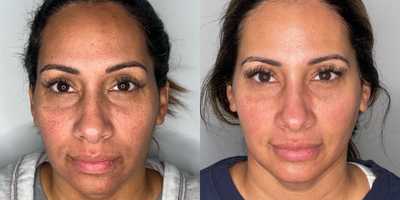 35-44 year old woman treated with DiamondGlow - patient treated with a series of DiamondGlow facials