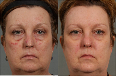 56 year old female treated for rosacea and facial spider veins - 
	Before: Rosacea creating redness, flushing of skin with spider veins. After: A series of 4 Laser Genesis treatments. Not reduction in skin redness and spider veins. Results are maintained twice a year. No downtime.

