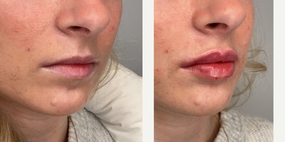 18-24 year old woman treated with Lip Fillers - patient treated with 1 syringe of RHA2
