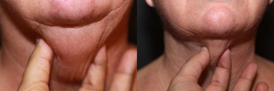 Laser Liposuction - Neck/Jowl - Laser Liposuction - Neck/Jowl