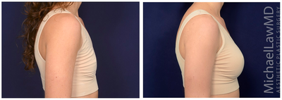 25-34 year old woman treated with Ideal Implant - Breast augmentation. Follow-up photos taken 3 months after the procedure.