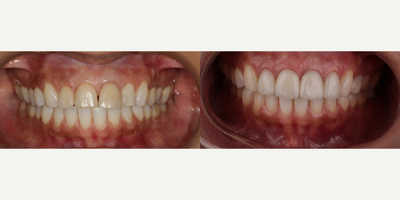 25-34 year old woman treated with Lumineers - Patient treated with porcelain veneers by Dr. Wilkin Medina at Dental Studio Spa Dominican Republic