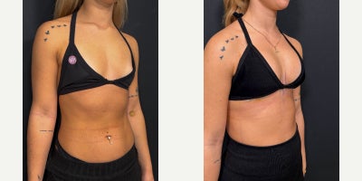 275 cc Motiva Full - dual-plane (submuscular) position - A 275 cc Motiva Full implant placed in a dual-plane (submuscular) position.