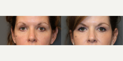 Restylane Silk - Stem cell rich fat to rejuvenate the volume and skin around the eyes.