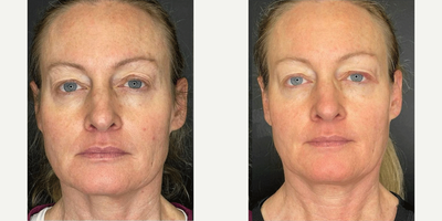Woman treated with Microneedling RF - Microneedling treatments for skin rejuvenation, scar reduction, and wrinkle reduction.