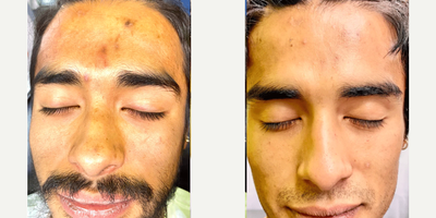 Man treated with Microneedling RF - Microneedling treatments for skin rejuvenation, scar reduction, and wrinkle reduction.