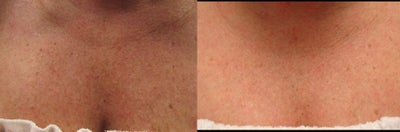 Fraxel Dual 1927 Thulium - 
	This is after only 1 treatment. Note dramatic improvement in discoloration.
