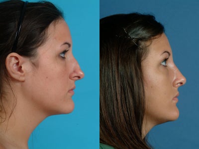 rhinoplasty - 
	This patient desired rhinoplasty for correction of her crooked nose.

