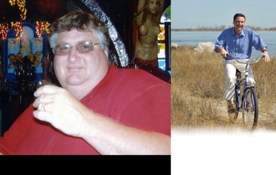 Gastric Bypass  - Patient lost 226 pounds