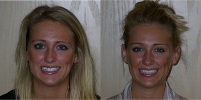 18-24 year old woman treated with Six Month Smiles - When crowded and rotate teeth result in an unaesthetic smile, then braces might be the solution. In this particular case we we able to straighten the teeth in about 4 months just in time for an important function.