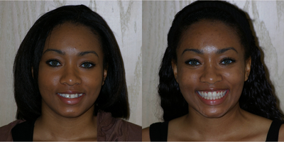 18-24 year old woman treated with Six Month Smiles - When a patient presents with crowded and rotated teeth then using brackets to effectively and efficiently move the teeth to their most ideal position is the answer. In inder six months, we were able to correct this patient's smile for outstanding aesthetics as well as function.