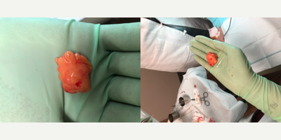 35-44 year old woman treated with Lipoma Removal - 35-44 year old woman treated with Lipoma Removal