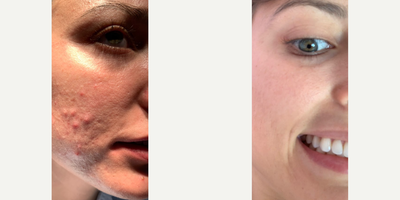 Woman treated with MiXto Laser, Venus Viva - Details - Acne treated with lasers and fillers
