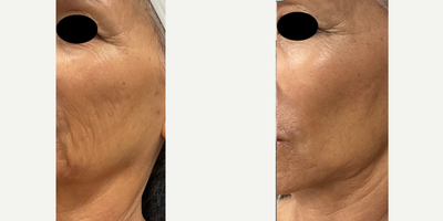 65-74 year old woman treated with Potenza - Potenza 3 sessions