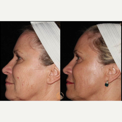 Woman treated with CO2 Laser - CO2RE, Fractional CO2 Resurfacing treatment