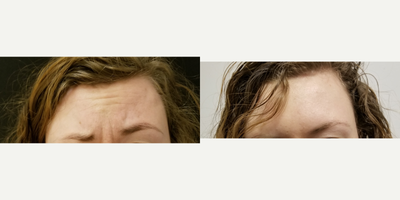 18-24 year old woman treated with Botox - Patient treated by Gretchen, NP-C with Botox for migraines and forehead wrinkles. Headaches improved with Botox treatment around eyebrows and at the hairline.