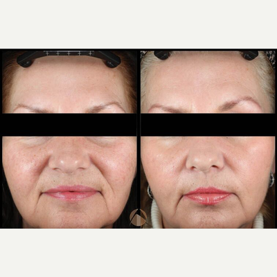 Woman treated with Profound RF - 1 Profound Treatment