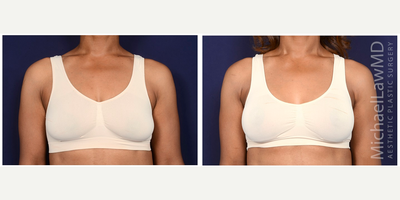 35-44 year old woman treated with Breast Lift with Implants - Augmentation mastopexy. Follow-up photos taken 6 months after the procedure.