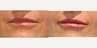 25-34 year old woman treated with Juvderm - Lips after injecting 1 syringe of Juvederm