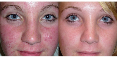 18-24 year old woman treated with Microdermabrasion - 6 Treatments Microdermabrasion