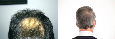 Hair Transplants - 	Crown Male Pattern Baldness Alopecia Treatment