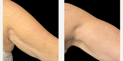 Woman treated with Sylfirm X - Woman treated with Sylfirm X