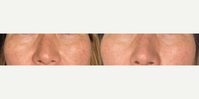 Woman treated with Sylfirm X - Woman treated with Sylfirm X