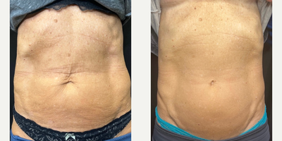 Woman treated with Sylfirm X - Woman treated with Sylfirm X