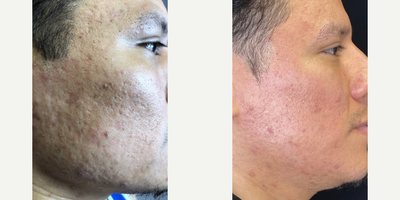 Woman treated with Sylfirm X - Woman treated with Sylfirm X