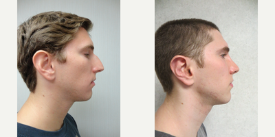 18-24 year old man treated with Rhinoplasty - This patient underwent a Rhinoplasty