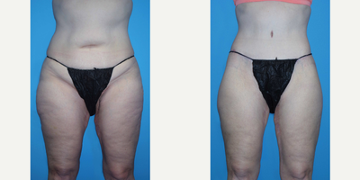 55-64 year old woman treated with Body Lift - 56 year old female received a circumferential abdominoplasty and body lift; photos depict the patients results 14 weeks post-op.