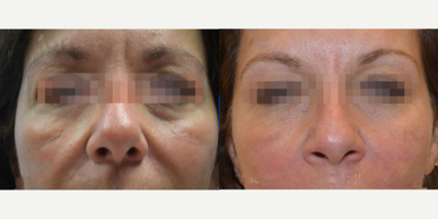 45-54 year old woman treated with Fractora RF for lower lids and mid face skin tighening - 45-54 year old woman treated with Fractora RF for lower lids and mid face skin tighening