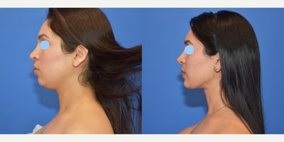 25-34 year old woman treated with Neck Lift, Chin Liposuction - Women treated with Neck lift and chin liposuction