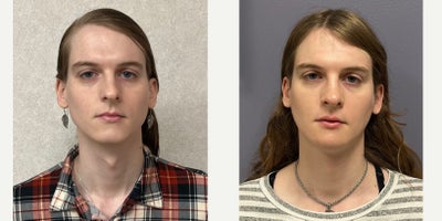 25-34 year old woman treated with Septoplasty, Revision Rhinoplasty, Facial Feminization Surgery, Adam's Apple Reduction - This young lady underwent septorhinoplasty, chondrolaryngoplasty, mandible/chin feminization.