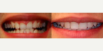 Woman treated with Invisalign - Patient presented with a chief complaint of childish looking teeth. She felt her teeth were uneven and yellow. Invisalign treatment took 12 months to complete followed by Zoom! Whitespeed in Office teeth whitening to brighten the newly aligned smile.