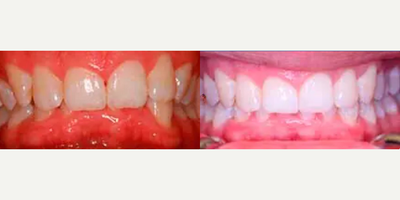 Woman treated with Invisalign - Patient presented with a chief complaint of childish looking teeth. She felt her teeth were uneven and yellow. Invisalign treatment took 12 months to complete followed by Zoom! Whitespeed in Office teeth whitening to brighten the newly aligned smile.