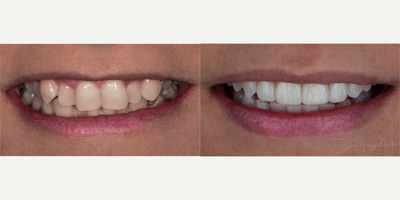 25-34 year old woman treated with Invisalign - Treatment completed with Invisalign, gum contouring and four anterior porcelain veneers for a minimally invasive result.