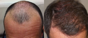 45-54 year old man treated with Hair Transplant - 9 months post Neograft with amazing growth.