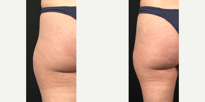 25-34 year old woman treated with Nonsurgical Butt Lift - Curious about a non-surgical BBL?  Using dilute Radiesse, we can fill in hip dips and enhance your curves without surgery! This minimally invasive treatment adds volume and smooths out your silhouette, giving you a fuller, more contoured shape.