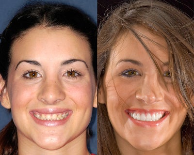 Implants restored with porcelain crowns - 
	Patient was missing 2 natural teeth and had completed orthodontic treament. She was unhappy with her smile. We place 2 implants and restored her smile with porcelain veneers and porcelain crowns. She feels this treatment transformed her smile.
