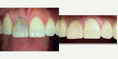 25-34 year old woman treated with Internal Tooth Bleaching - Female patient, assist to consultation for internal tooth bleaching. Heres the pictures of before and after
