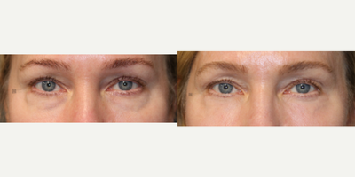 Enigmalift Scarless Lower Eyebag Removal and Laser - Enigmalift Scarless lower Eyebag Removal and Laser Resurfacing with Minimally Invasive Approach.