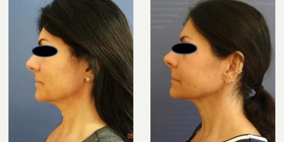 Woman treated with Fractora RF - Fractora Firm Lower Face + Neck