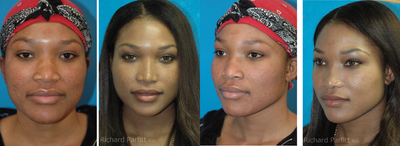 30 year old African American Rhinoplasty Madison WI - 
	This patient didn't like the width of her nose, and wanted a more refined feminine nose, but also wanted to maintain her ethnic features. Narrowing was accomplished by narrowing the base as well as the upper boney pyramid of the nose.&nbsp;
